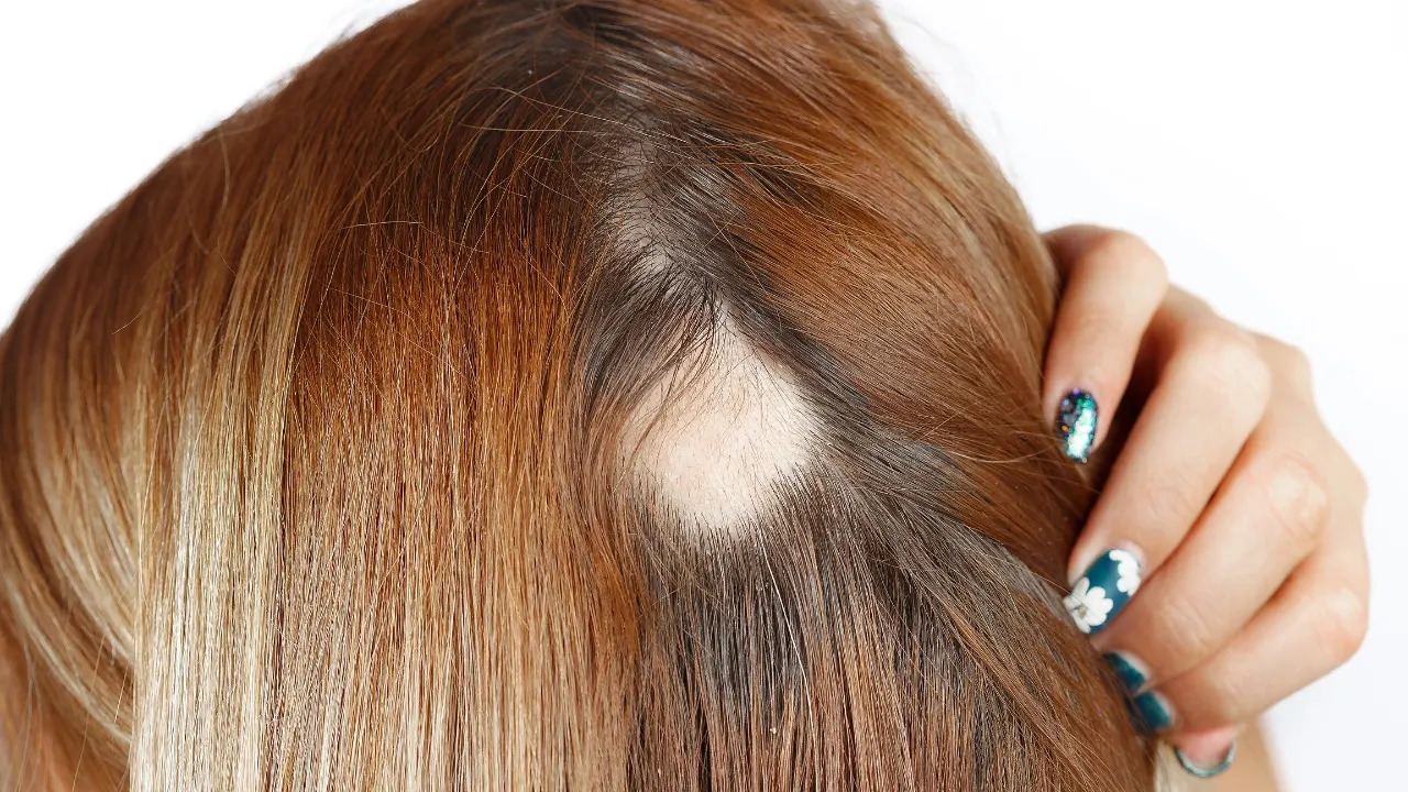 Alopecia areata.