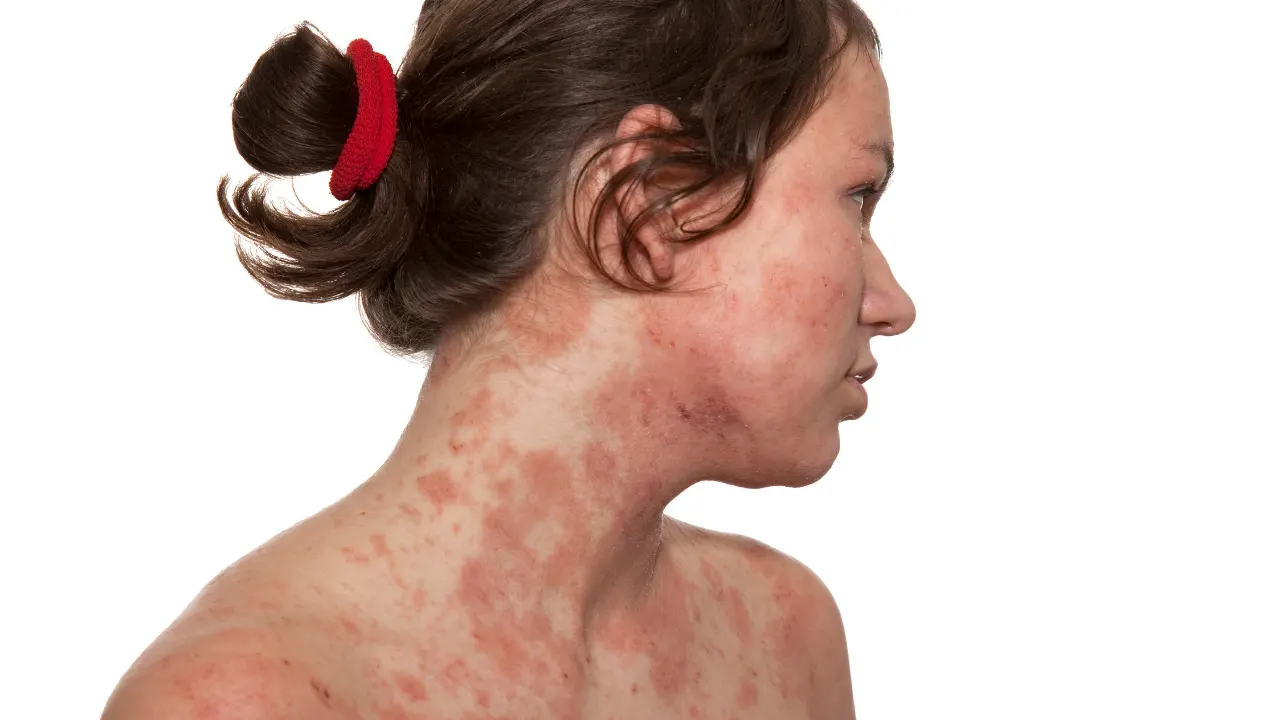 Autoimmune Progesterone Dermatitis.